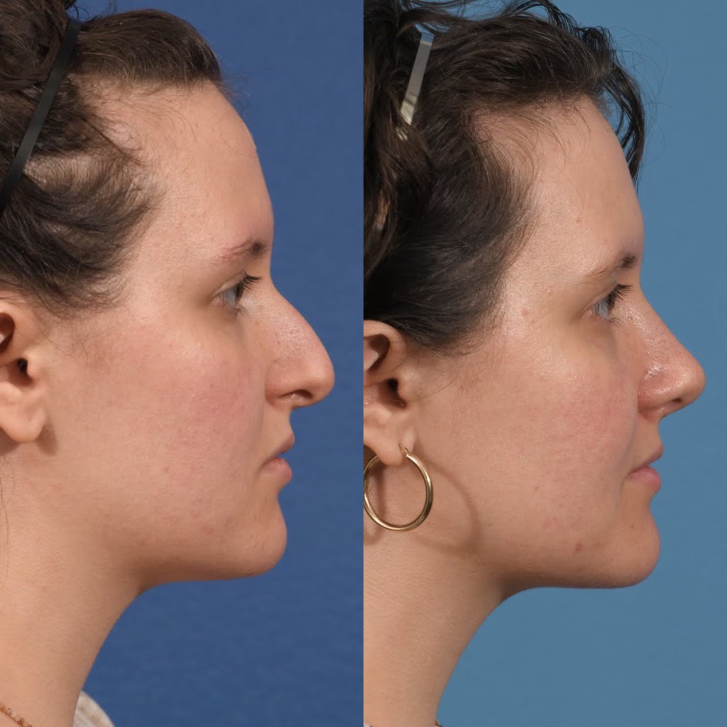 Septoplasty Before & After #20