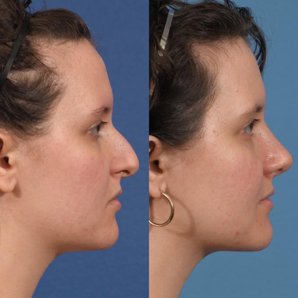 Septoplasty Before & After #20