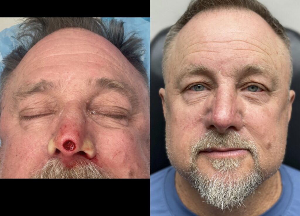 MOHS Reconstruction Before & After 7