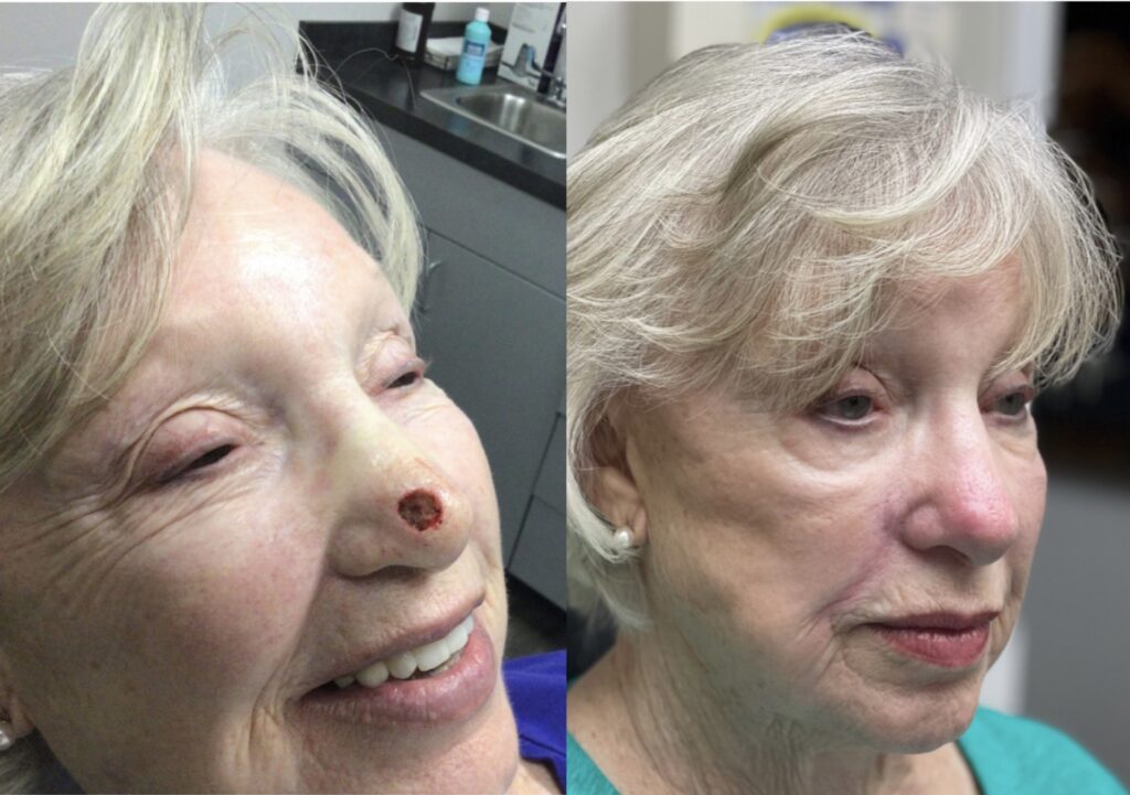 MOHS Reconstruction Before & After 4 before and after