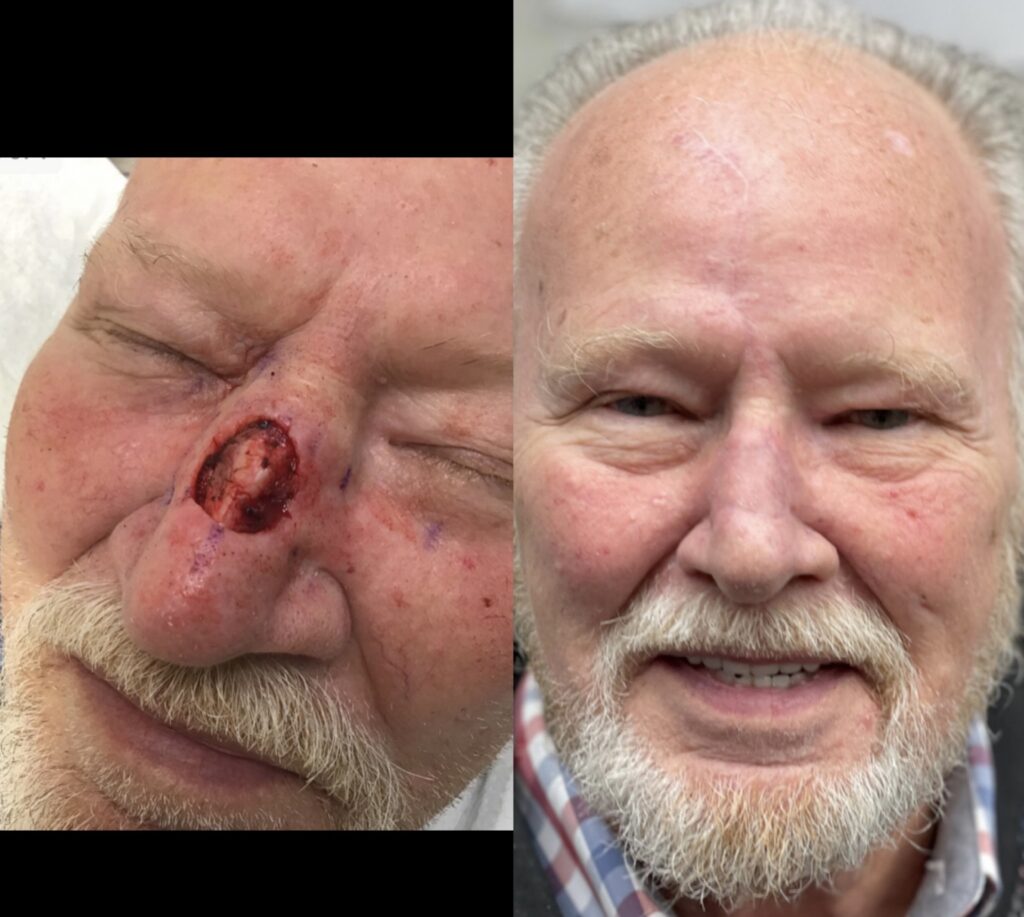 MOHS Reconstruction Before & After 6
