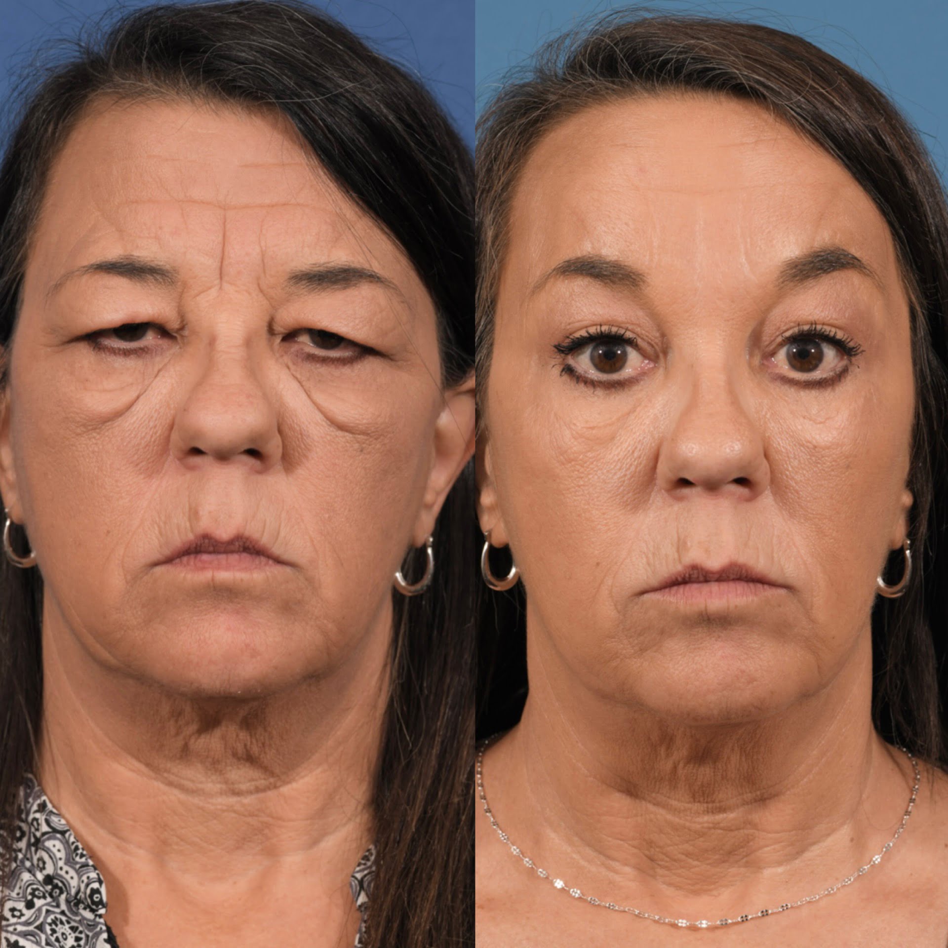 Blepharoplasty Before & After #4 image 6