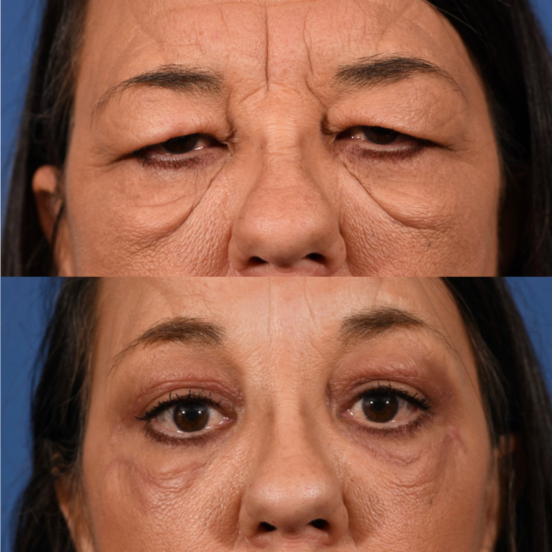 Blepharoplasty Before & After #4 image 5