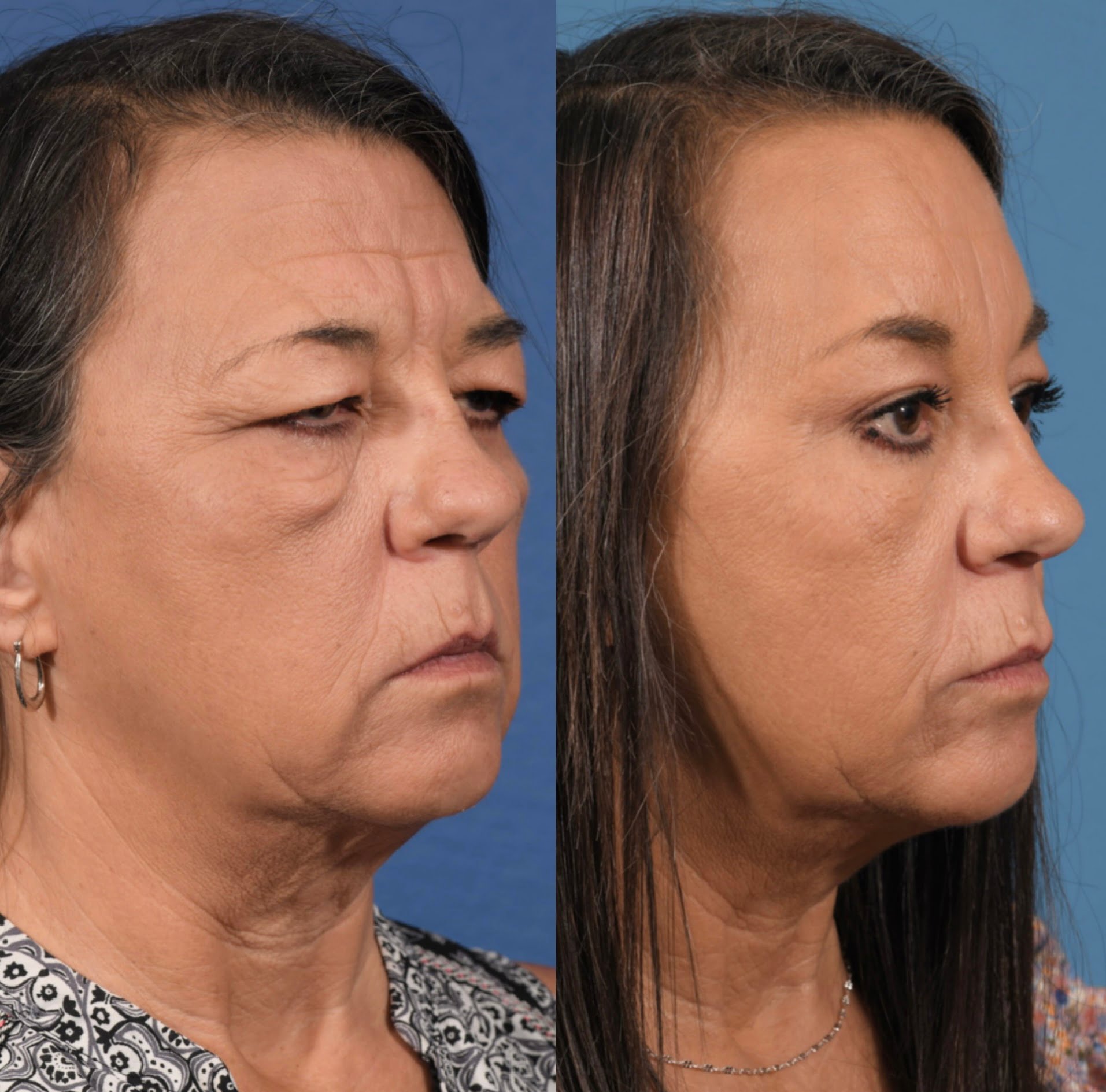 Blepharoplasty Before & After #4