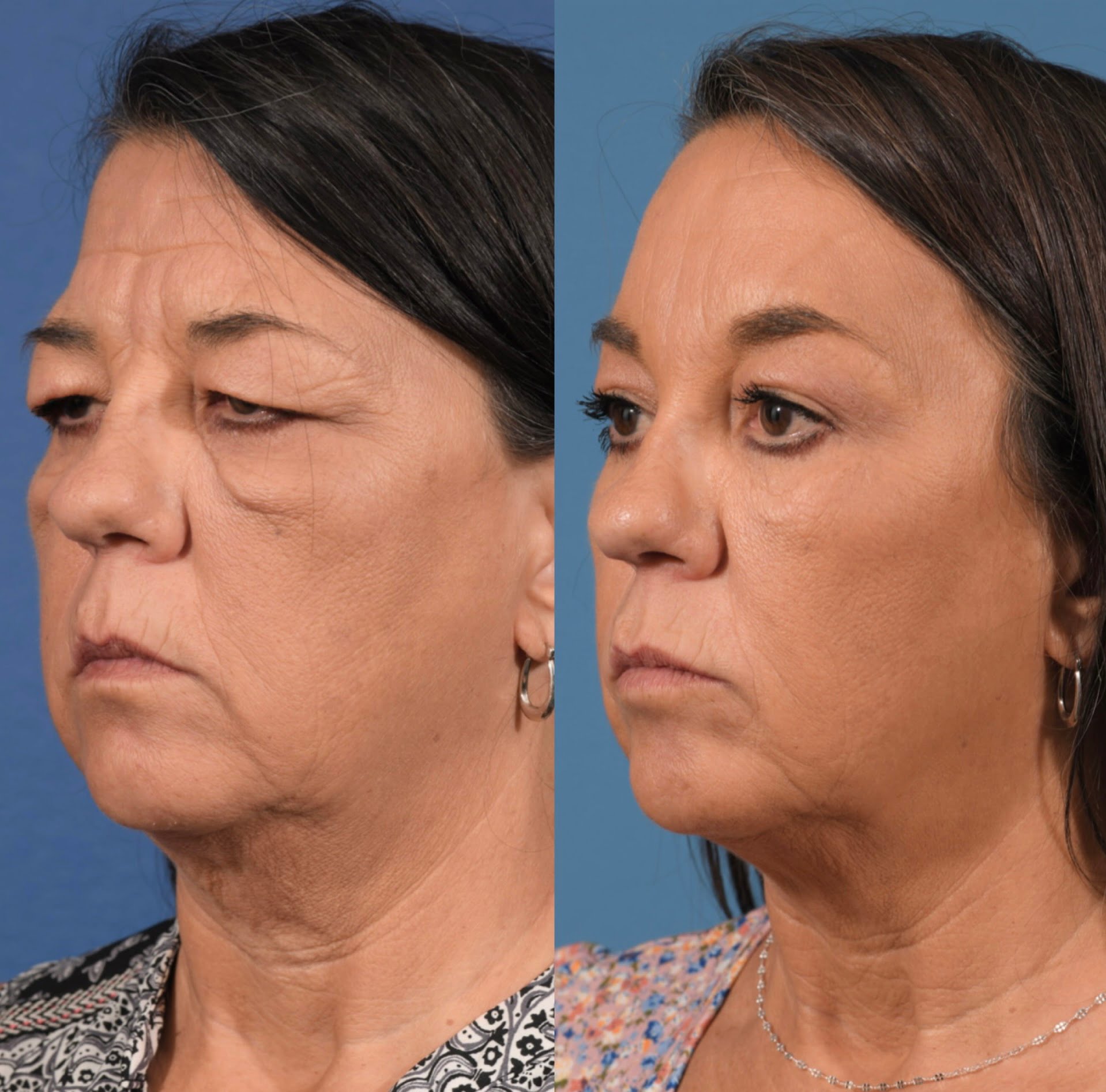 Blepharoplasty Before & After #4 image 3