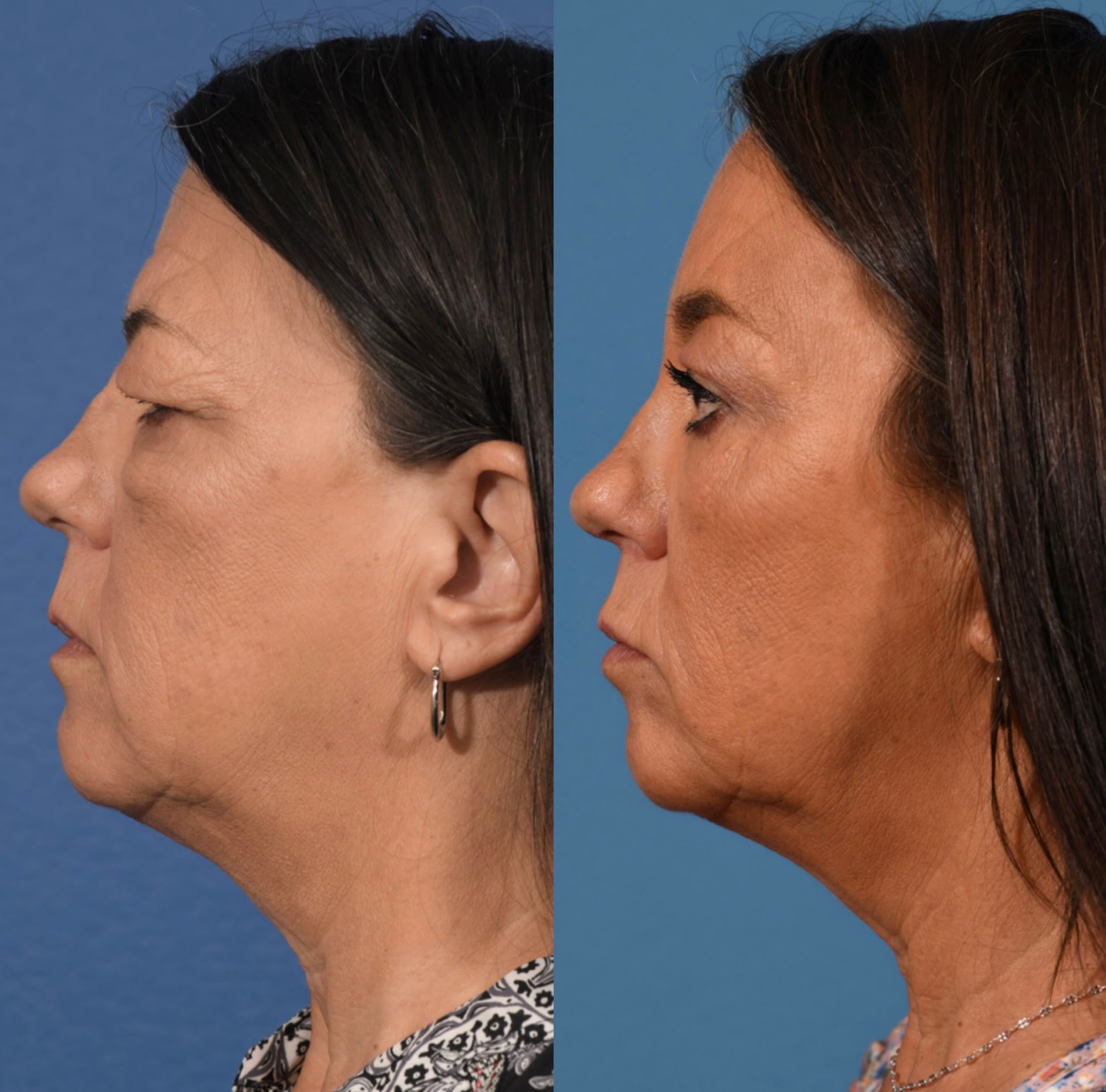 Blepharoplasty Before & After #4 image 2