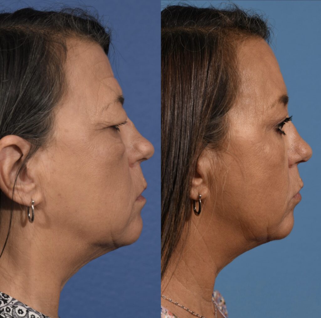 Blepharoplasty Before & After #4