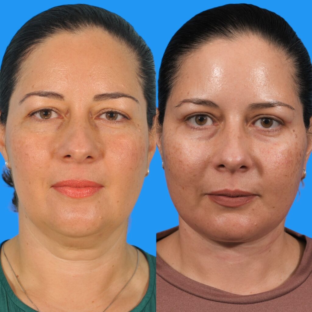Neck Lift #1 before and after