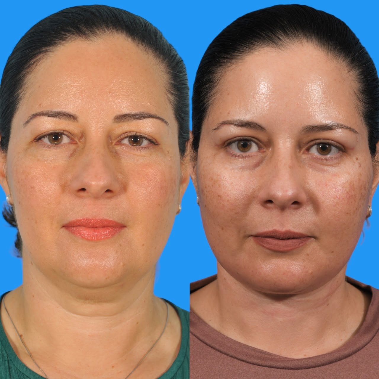 Neck Lift #1