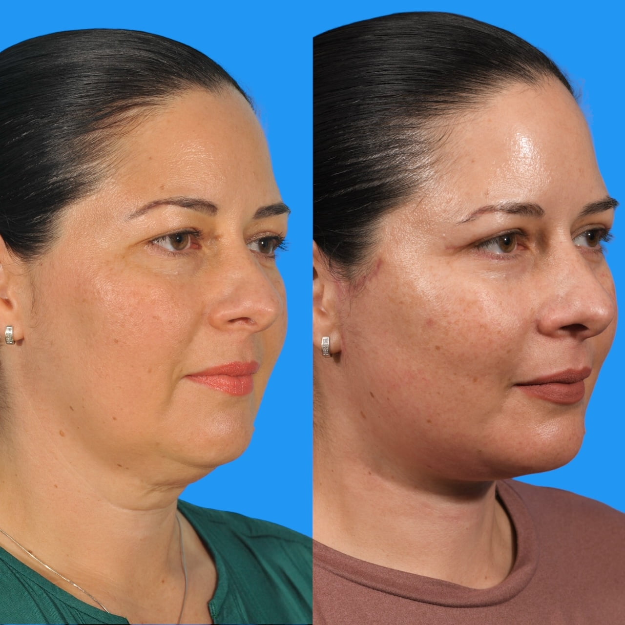 Neck Lift #1 image 3