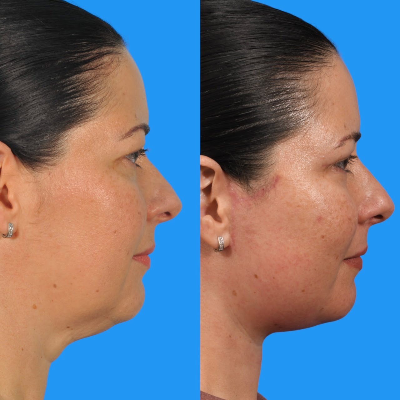 Neck Lift #1 image 2