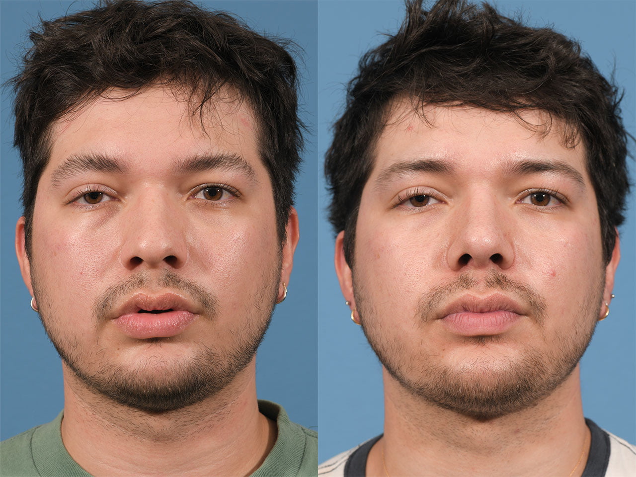 Rhinoplasty Before & After #22 image 5