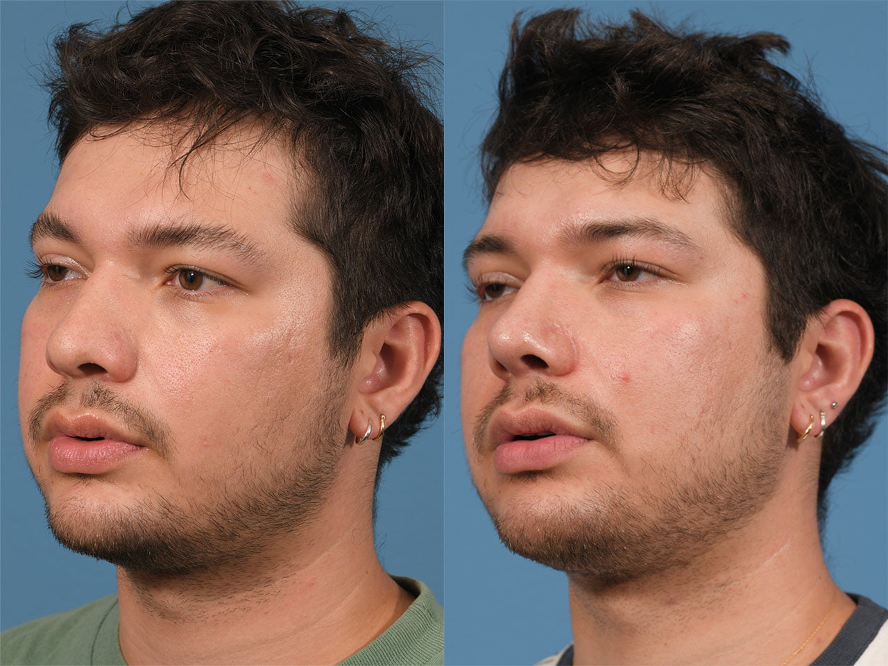 Rhinoplasty Before & After #22 image 4