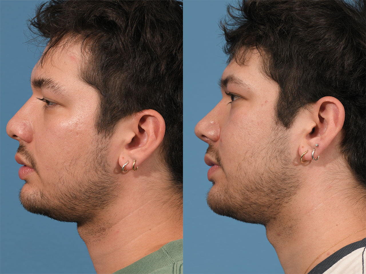 Rhinoplasty Before & After #22 image 3
