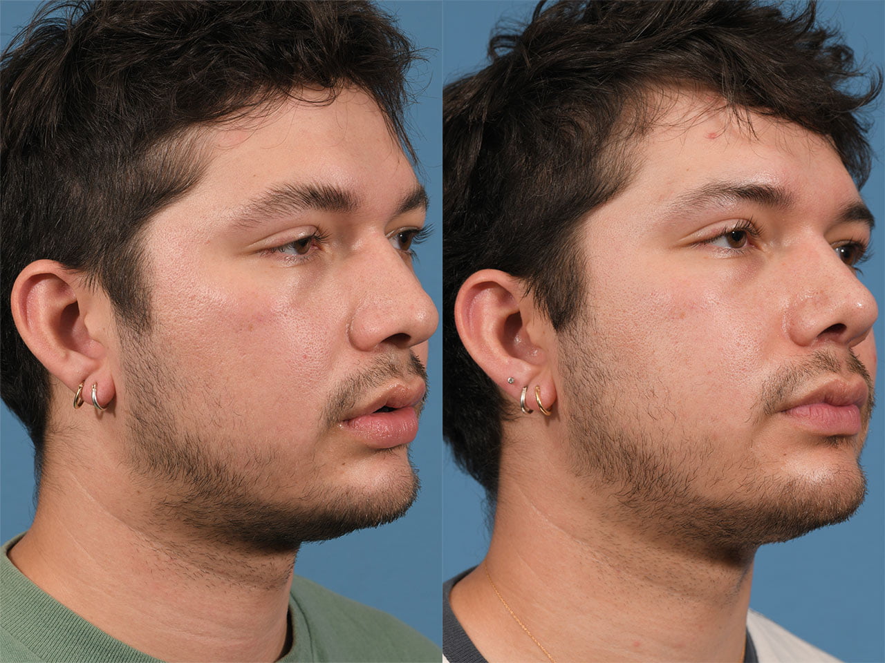 Rhinoplasty Before & After #22 image 2