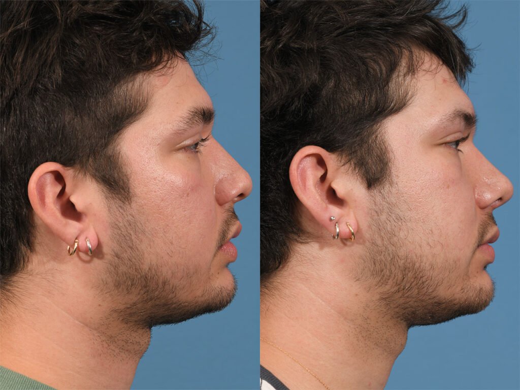 Rhinoplasty Before & After #22 before and after