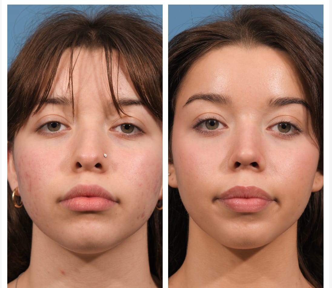 Rhinoplasty Before & After #23 image 5