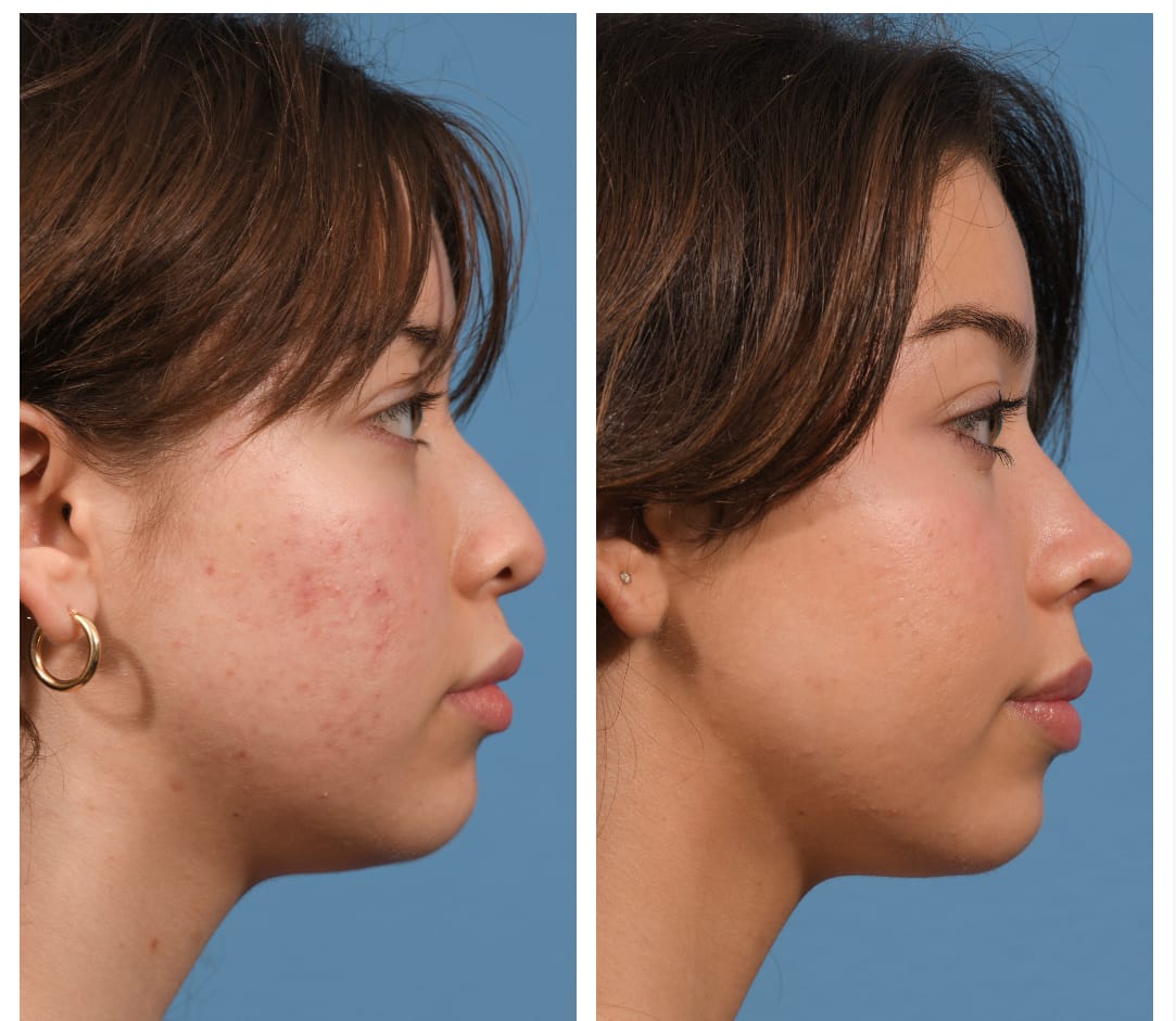 Rhinoplasty Before & After #23