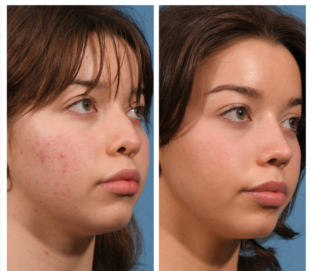 Rhinoplasty Before & After #23 image 3