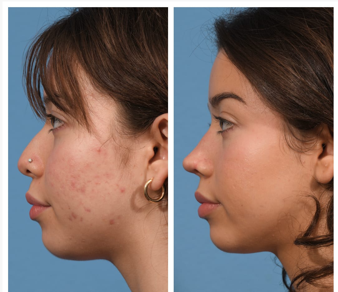 Rhinoplasty Before & After #23 image 2