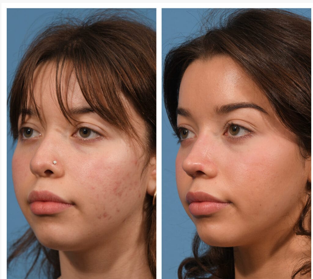 Rhinoplasty Before & After #23