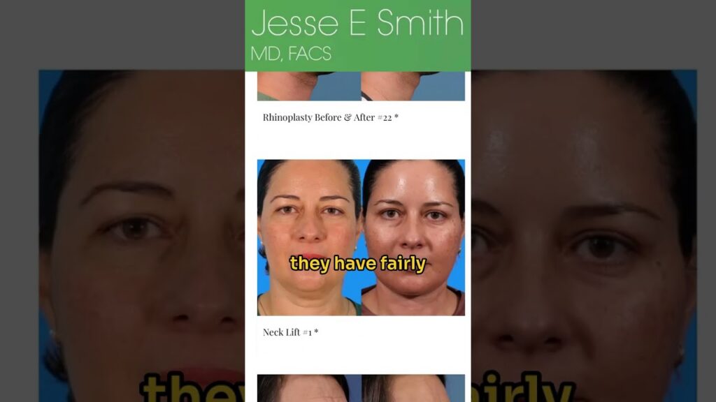 What To Ask a Rhinoplasty Surgeon