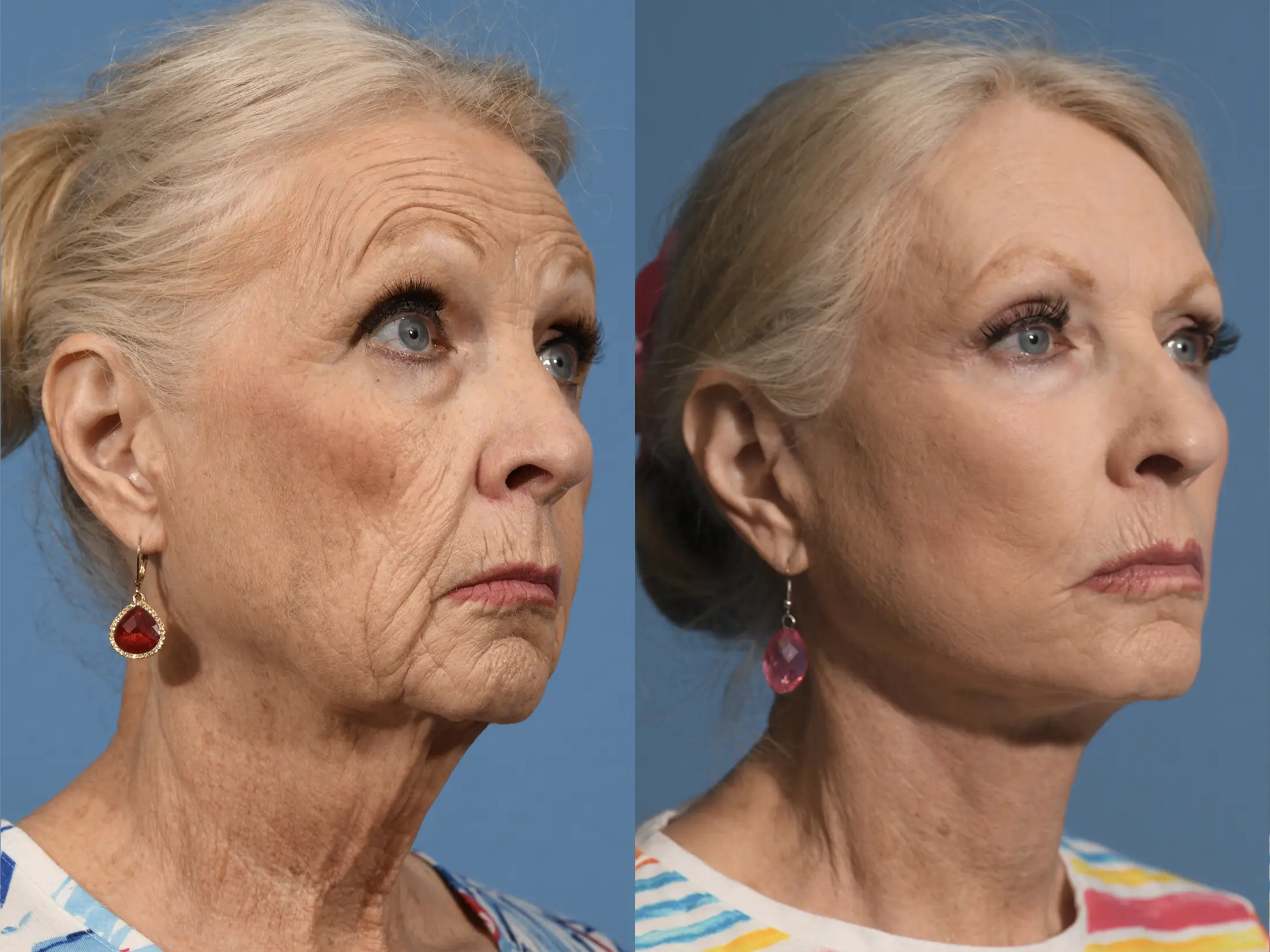 Facelift Before & After #3 image 2