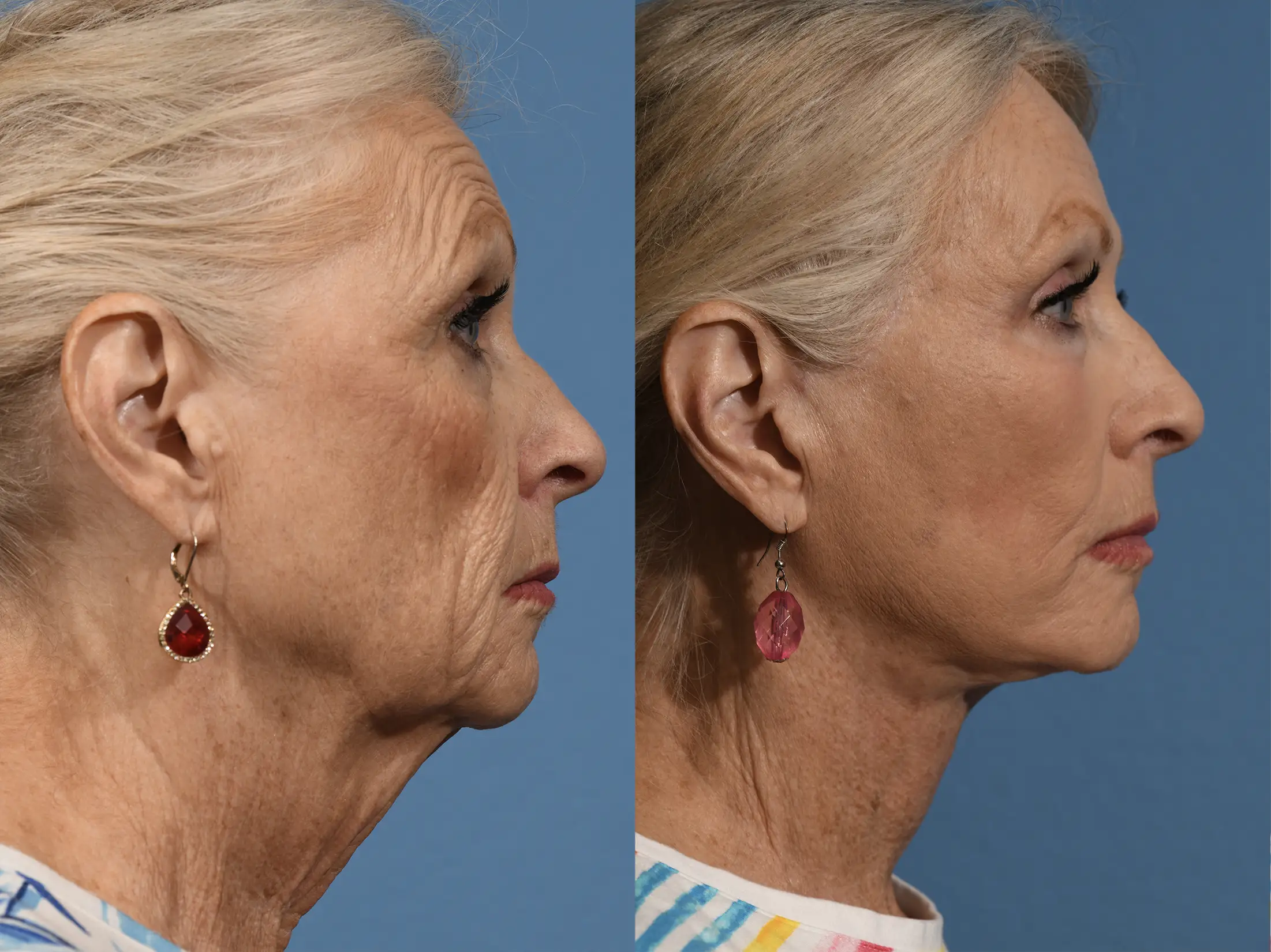 Facelift Before & After #3 image 3