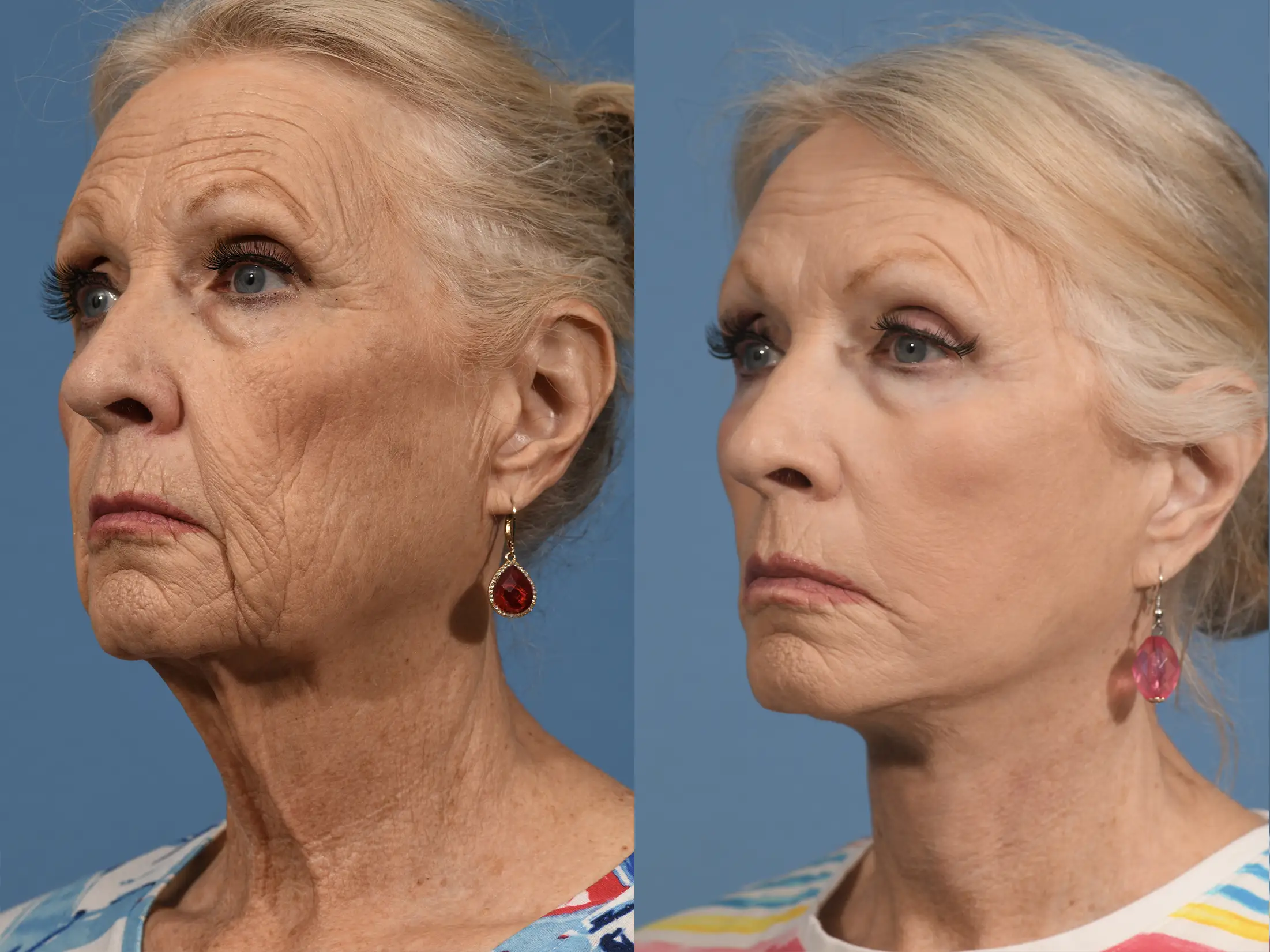 Facelift Before & After #3 image 4