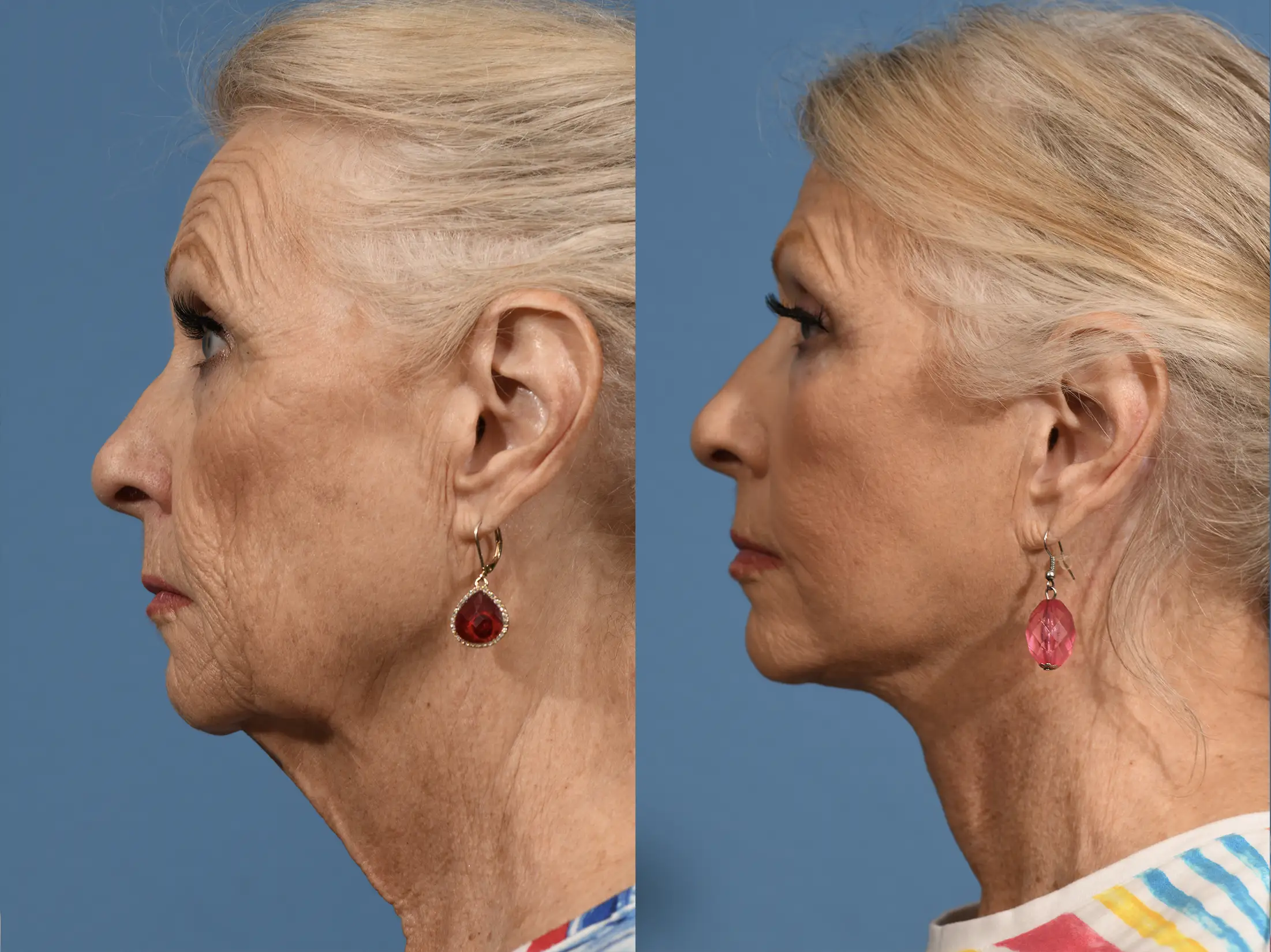 Facelift Before & After #3 image 5