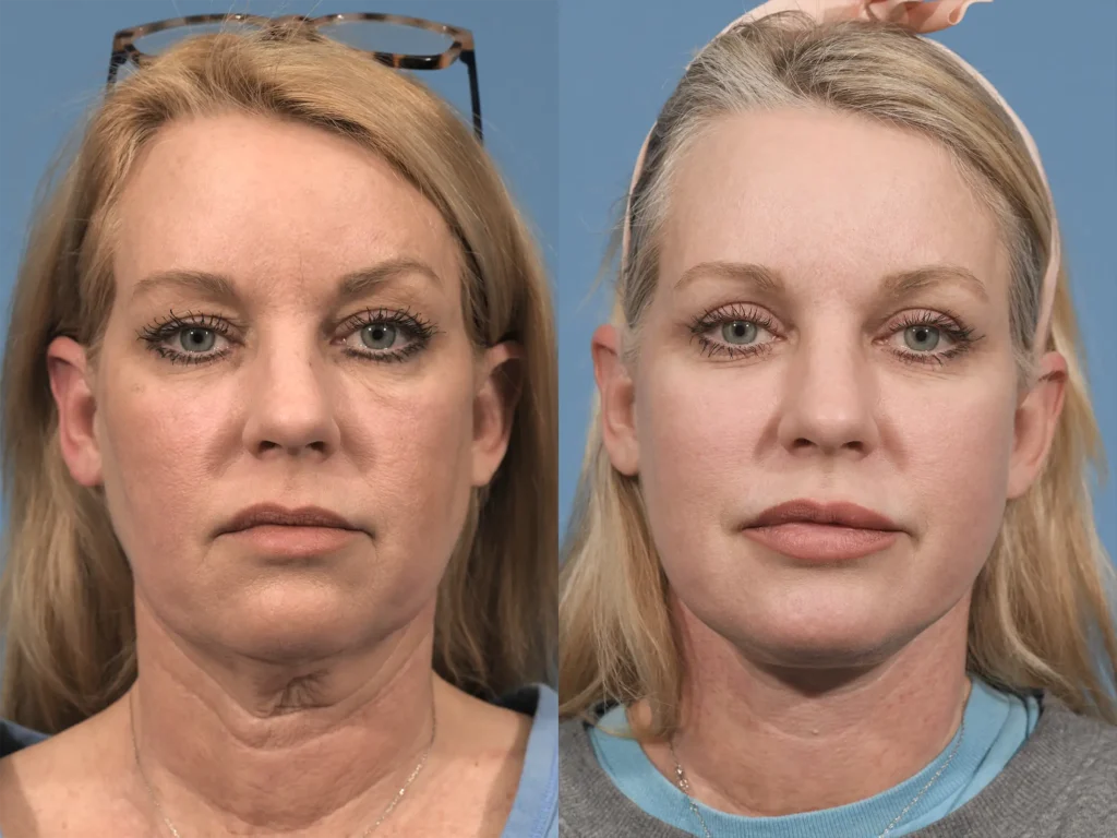 Neck Lift Before & After #2