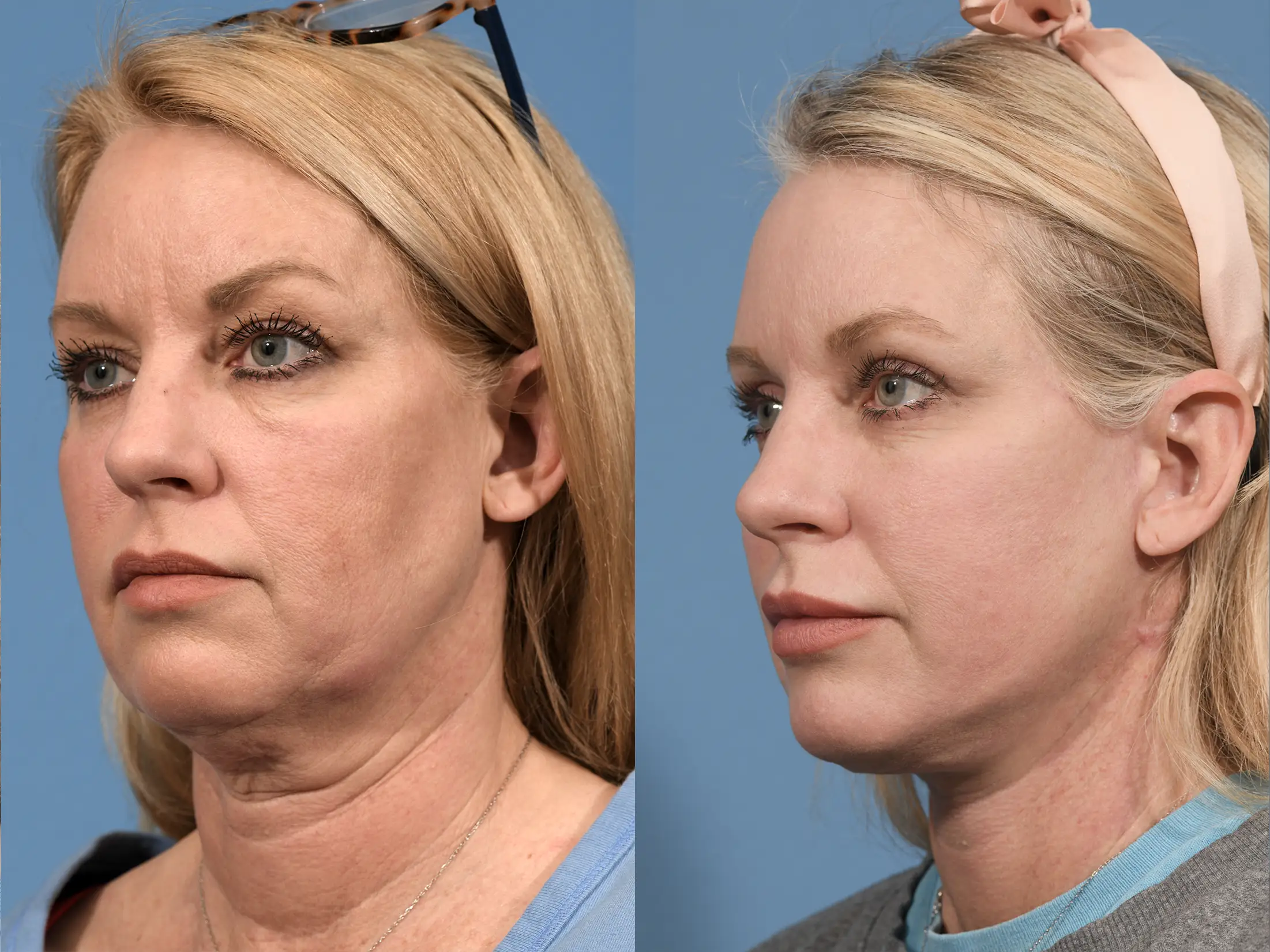 Neck Lift Before & After #2 image 4