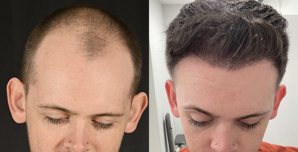 Hair Transplant Before & After #11 before and after