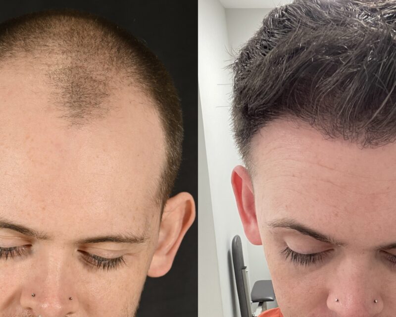 Hair Transplant Before & After #11