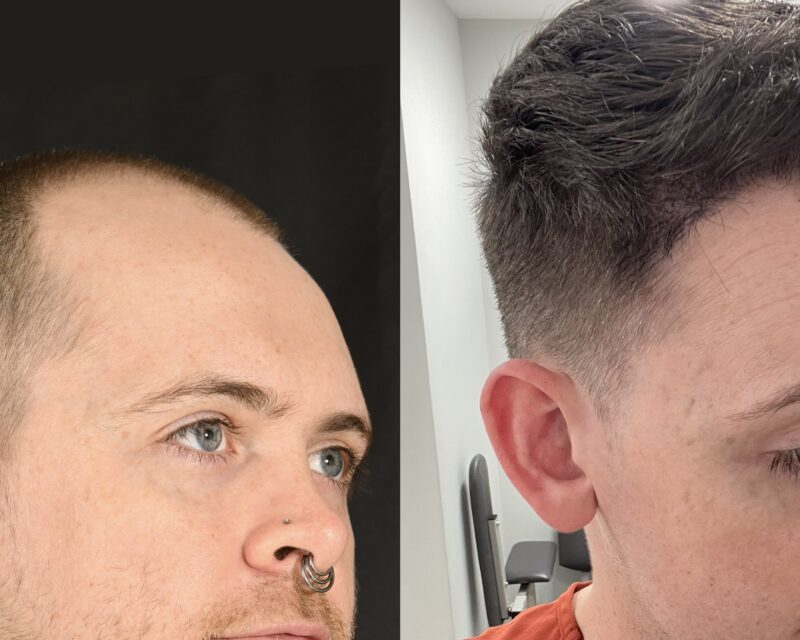 Hair Transplant Before & After #11 image 2
