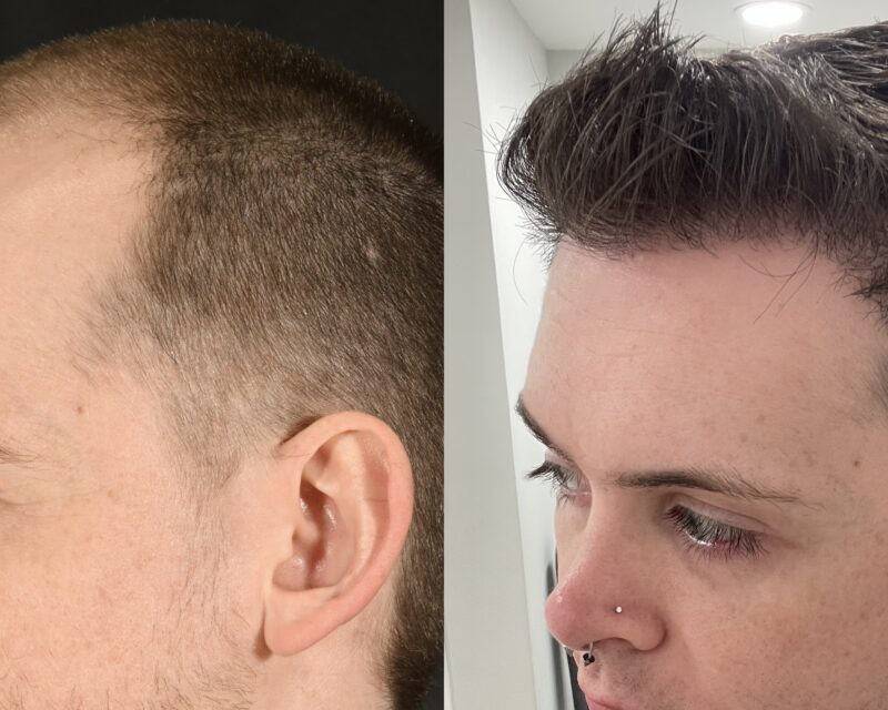 Hair Transplant Before & After #11 image 3
