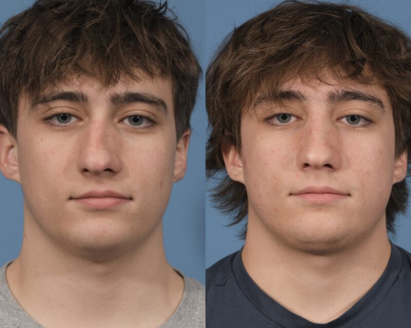 Rhinoplasty Before & After #27