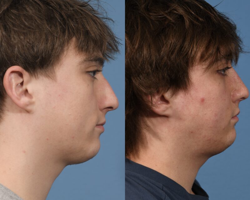Rhinoplasty Before & After #27 image 2