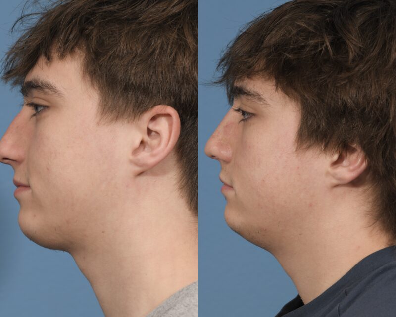 Rhinoplasty Before & After #27 image 3