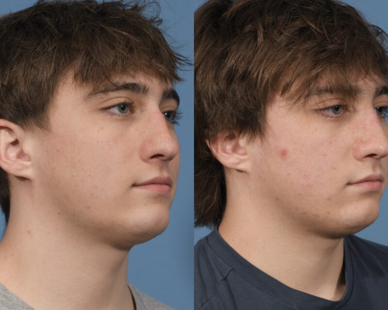 Rhinoplasty Before & After #27 image 4