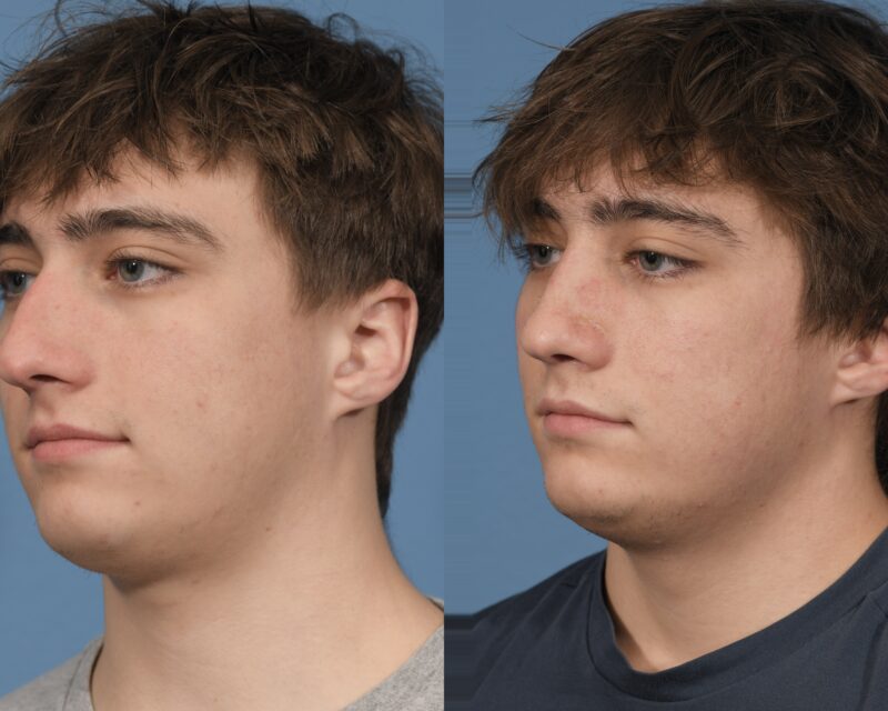 Rhinoplasty Before & After #27 image 5