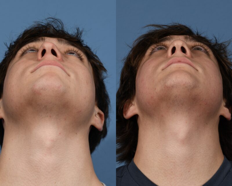 Rhinoplasty Before & After #27 image 6