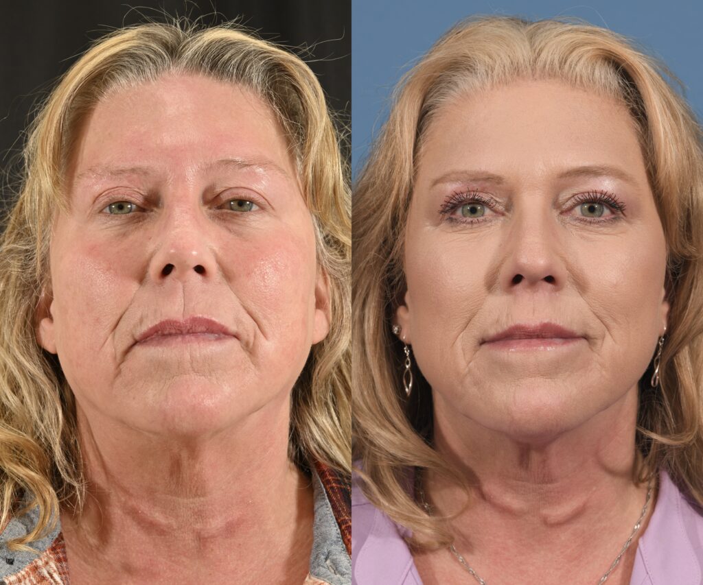 Lip Lift Before & After #1 before and after