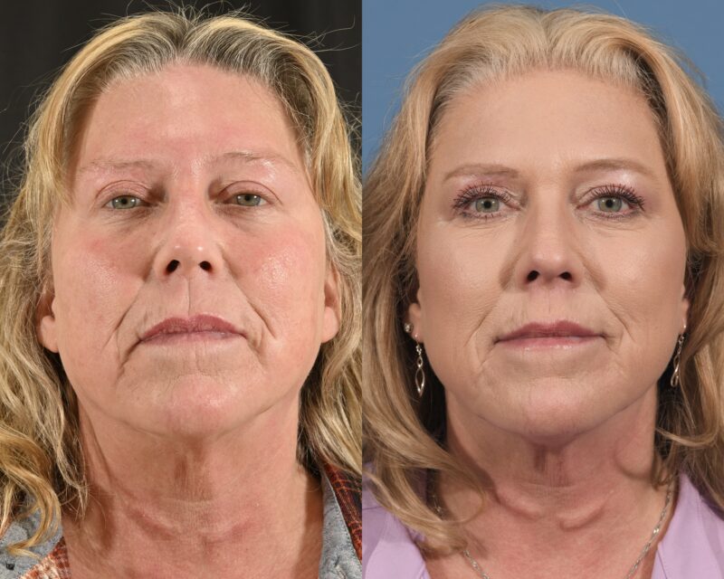 Lip Lift Before & After #1