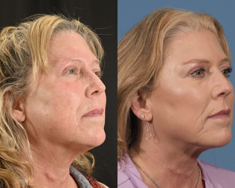Lip Lift Before & After #1 image 2