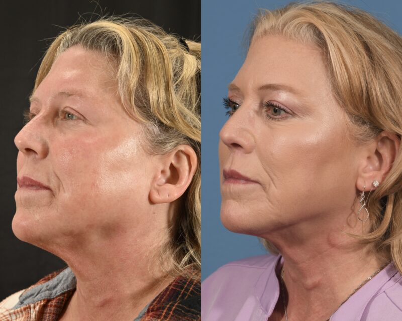 Lip Lift Before & After #1 image 3
