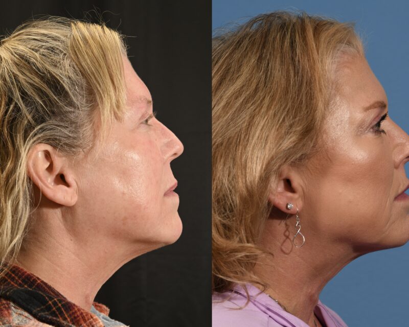 Lip Lift Before & After #1 image 4