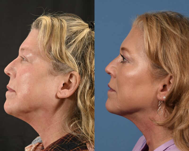 Lip Lift Before & After #1 image 5