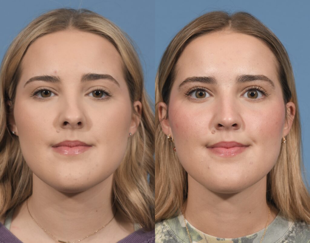 Rhinoplasty Before & After #26 before and after