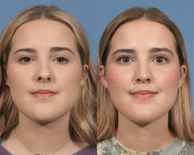 Rhinoplasty Before & After #26